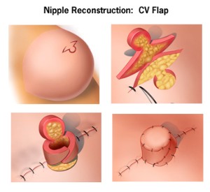 nipple-cv-flap